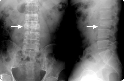 일반 엑스레이 사진에서 제3요추의 방출성 골절이 관찰된 사진