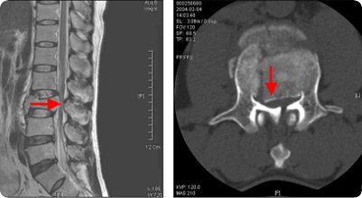 좌측의 MRI 사진과 우측의 CT사진에서 제3요추체가 심하게 부서져서 뒤쪽의 신경을 누르고 있는 소견 사진